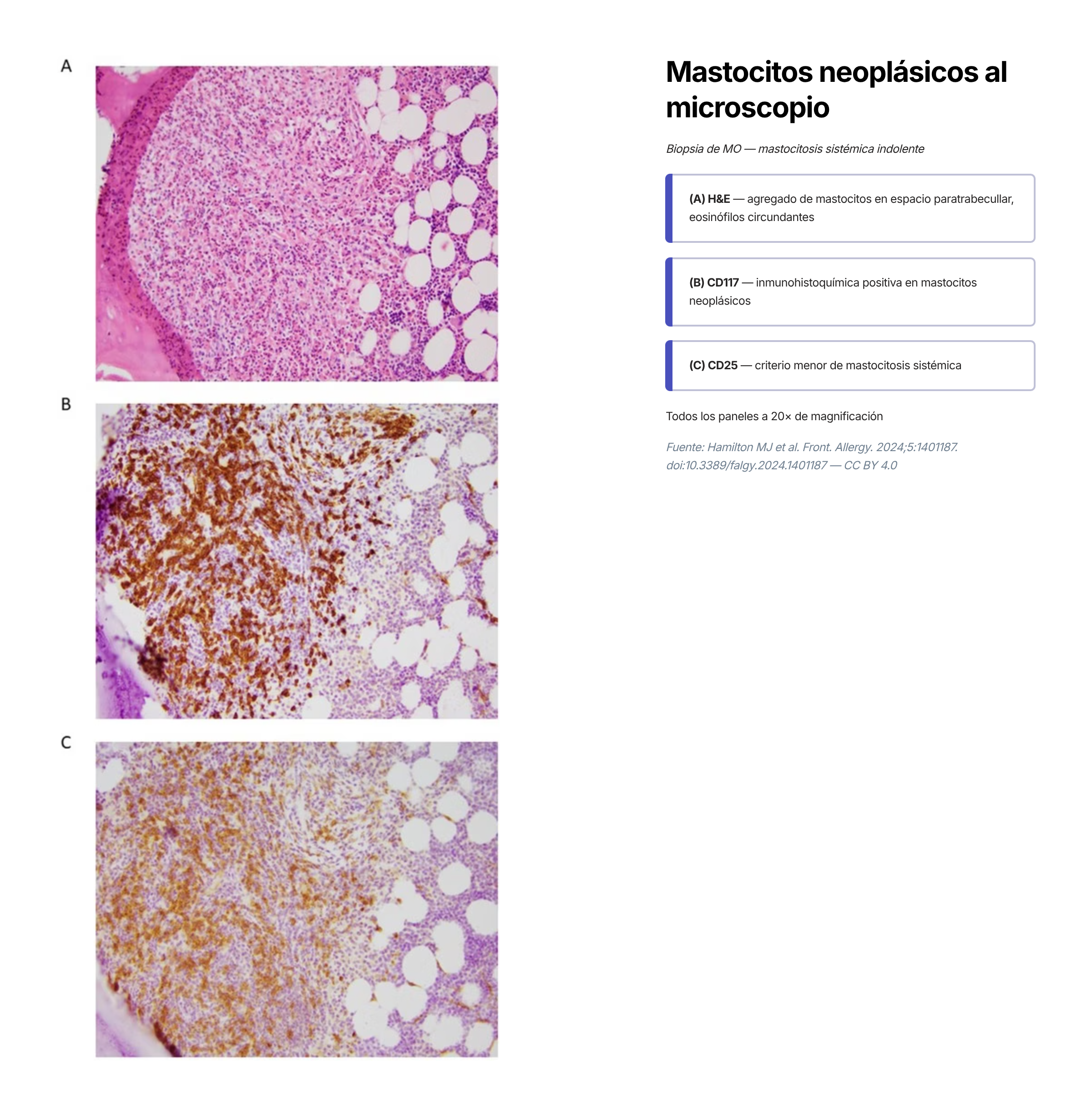 Serie de tres micrografías clínicas reales. En el aspirado de médula ósea se observan mastocitos atípicos, de contorno redondeado a fusiforme, con prolongaciones del citoplasma, escasa granulación y gránulos de distribución irregular. En el corte histológico de médula ósea se aprecia un infiltrado multifocal denso con más de 15 mastocitos agrupados, hallazgo que constituye el criterio mayor de mastocitosis sistémica. En la biopsia de piel se muestra el aumento de mastocitos con expresión de CD117 y triptasa por inmunohistoquímica.