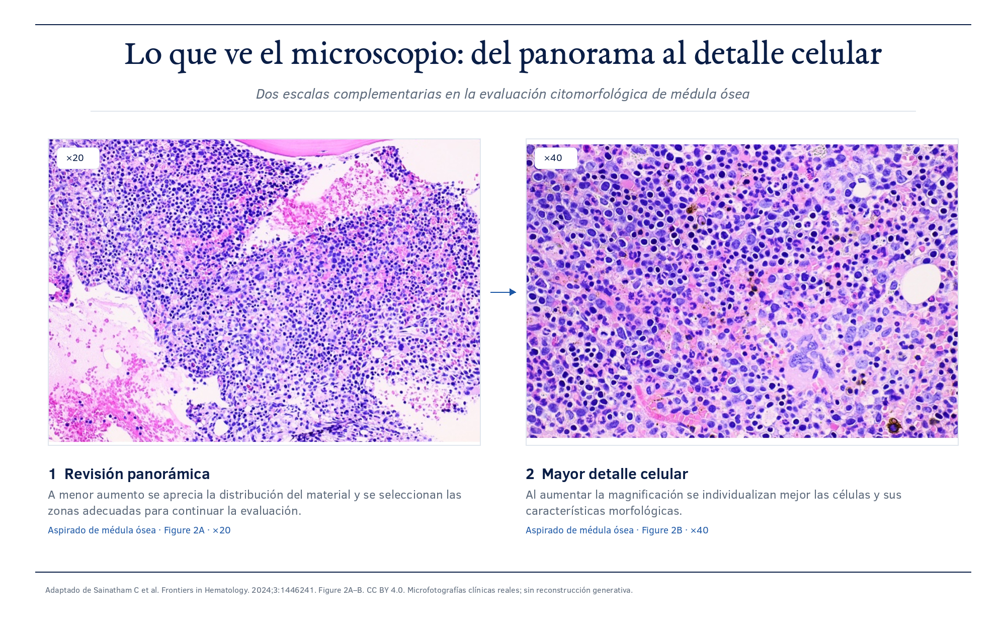 Dos microfotografías reales de un extendido hematológico. En el panel izquierdo, la revisión panorámica a bajo aumento de un extendido de médula ósea, donde pueden valorarse la celularidad, la distribución de las poblaciones celulares y la calidad y representatividad de la muestra. En el panel derecho, un campo representativo del mismo extendido a mayor aumento, con células individuales nítidas y etapas de maduración reconocibles, que corresponde al nivel de observación del recuento diferencial. Cada panel incluye una barra de escala micrométrica. No hay señalamientos ni rótulos de diagnóstico sobre las imágenes.