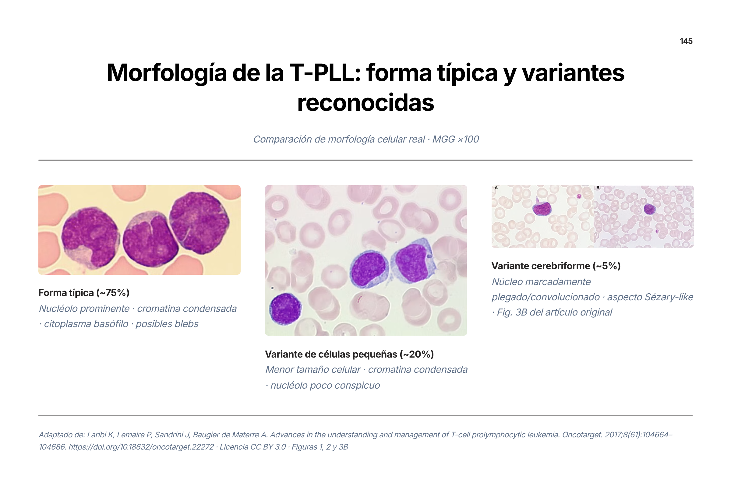 Tres microfotografías de frotis de sangre periférica con los patrones morfológicos de la leucemia prolinfocítica de células T. La primera muestra la forma prolinfocítica típica, presente en alrededor de 75% de los casos, con células de tamaño mediano, núcleo de contorno regular, cromatina ligeramente laxa, nucléolo prominente y citoplasma basófilo que puede tener prolongaciones. La segunda muestra la variante de células pequeñas, cercana a 20% de los casos, con cromatina muy condensada y nucléolo poco visible. La tercera muestra la variante cerebriforme, aproximadamente 5% de los casos, con contorno nuclear irregular y plegado, parecido al de las células de Sézary. Cada imagen lleva una barra de escala del mismo valor.