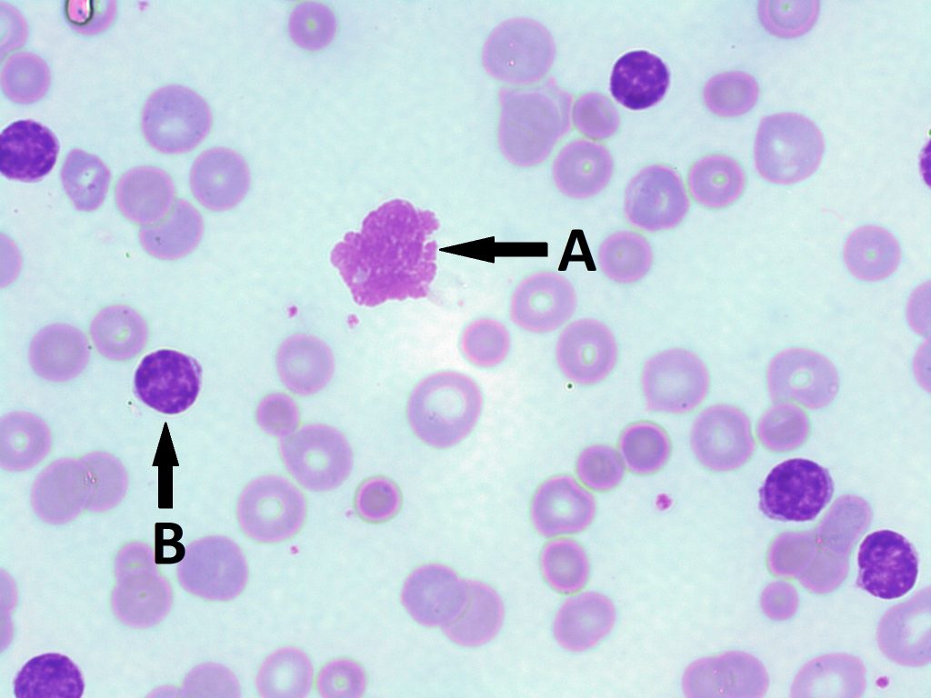 Frotis sanguíneo al microscopio con células púrpuras: célula irregular (A) y redonda (B). Diferencias en tamaño y forma.