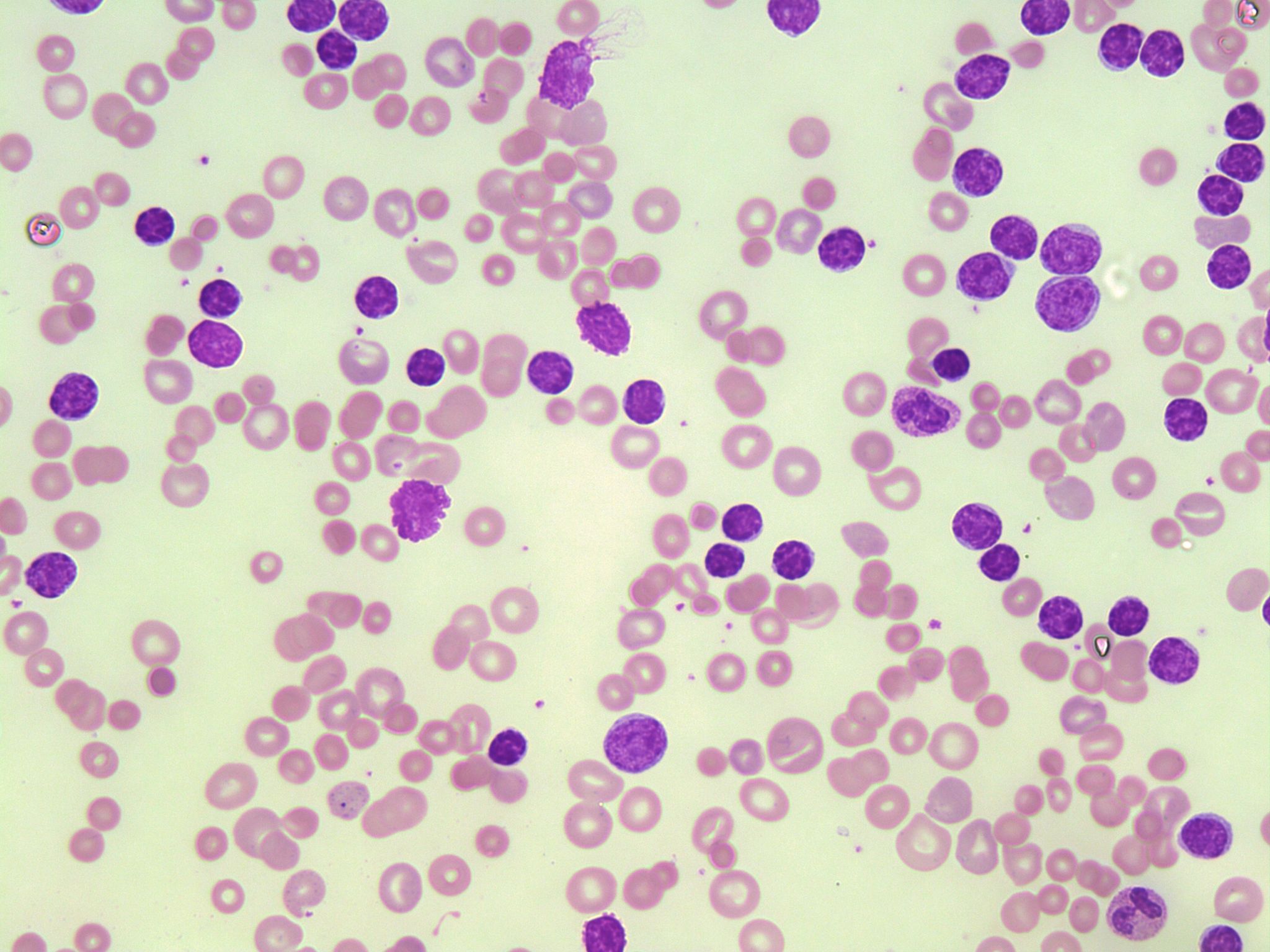 Imagen microscópica de un frotis de sangre con múltiples células de color púrpura y diferentes tamaños, sobre fondo claro.