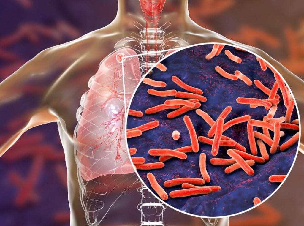 Tuberculosis: diagnóstico, síntomas y terapia farmacológica